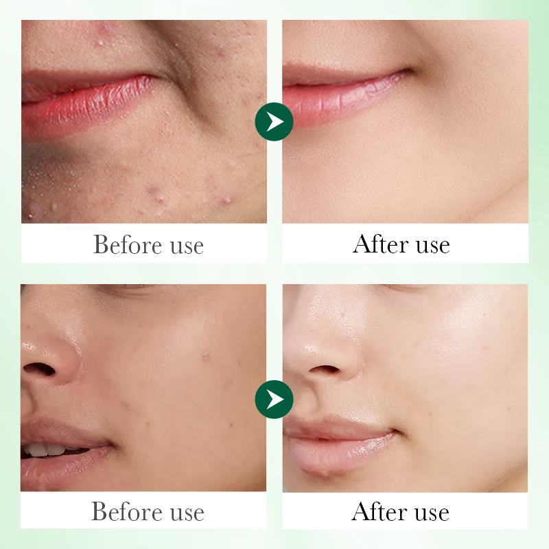 3% Salicylic Acid (Acne Repair Serum) - Image 4
