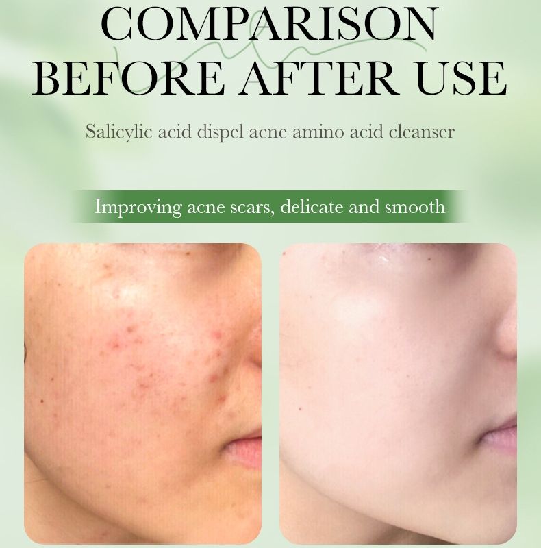 Salicylic 3% Acid Cleanser (ফেসওয়াশ) - Image 4